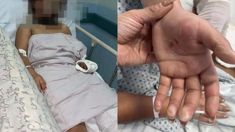 Una mujer fue atacada con ácido en Michoacán