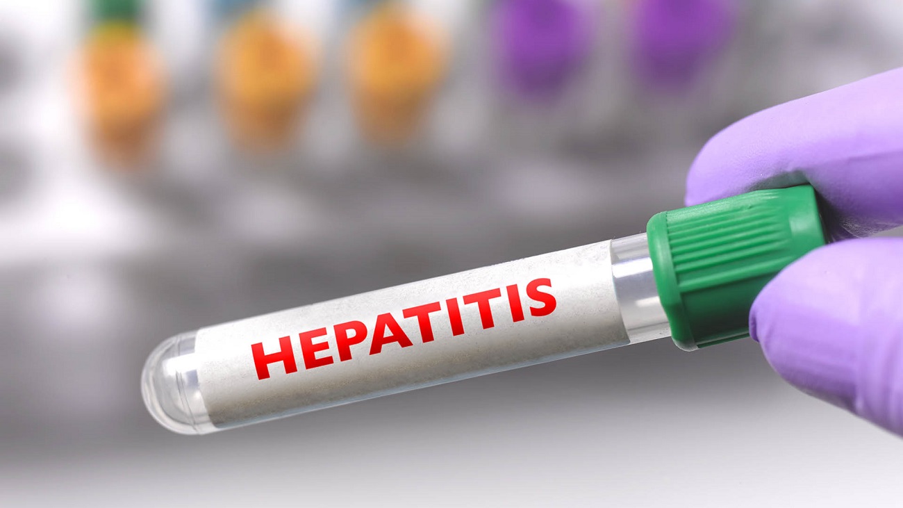 casos sospechosos de hepatitis