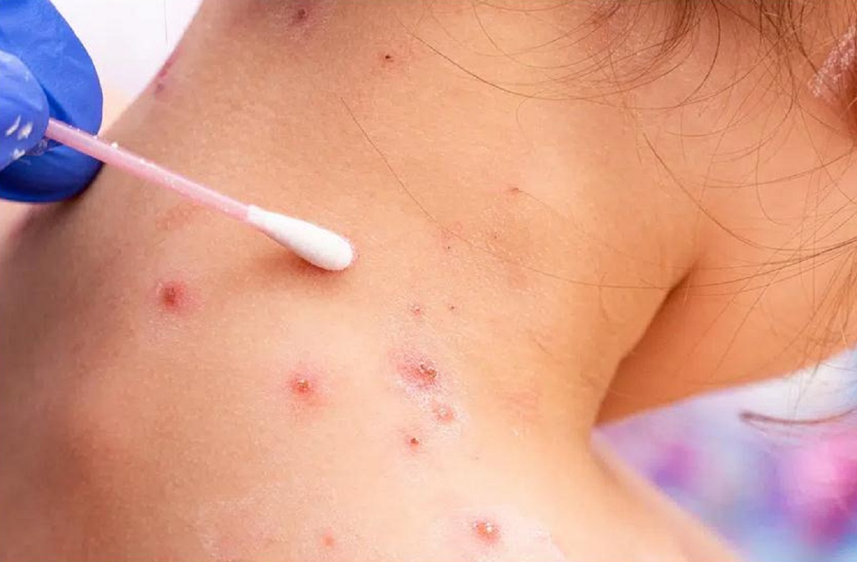 segundo caso de viruela del mono en el país