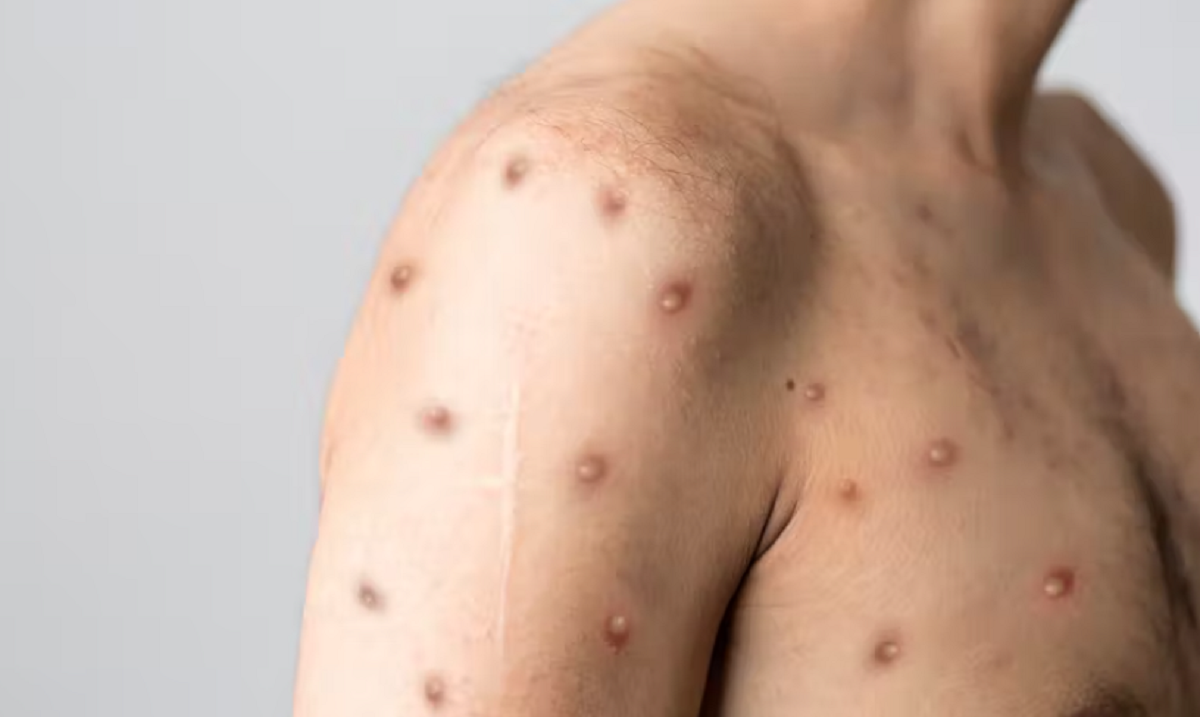 México ya registra el segundo caso