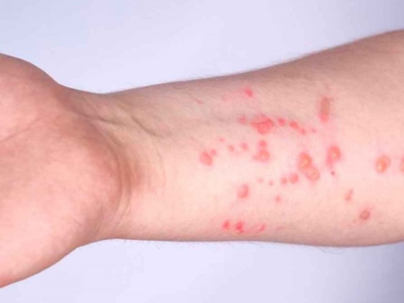 México confirma 147 casos de viruela del mono. Unas 390 personas cumplen la definición de caso probable según Salud.