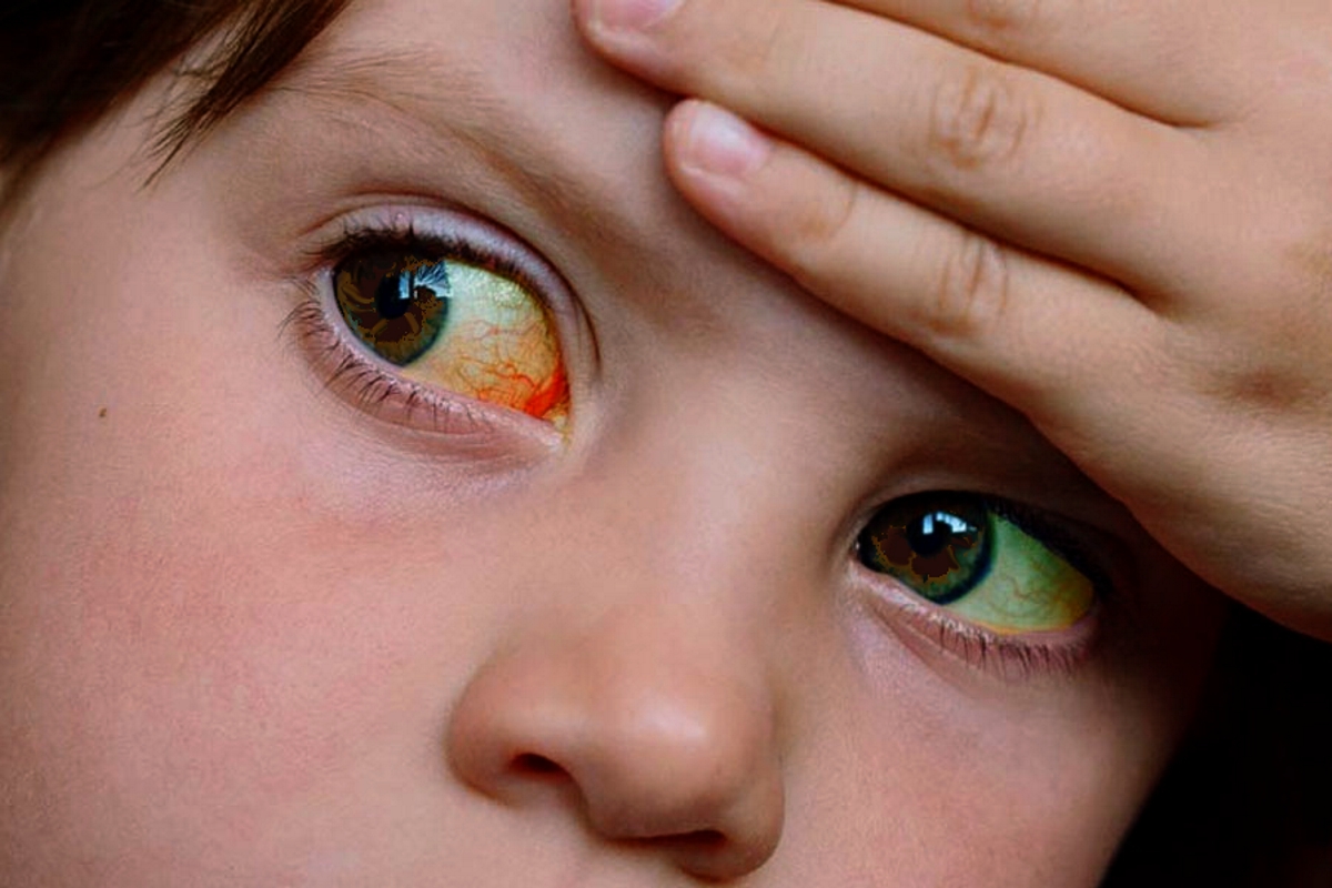 hepatitis infantil aguda en el país