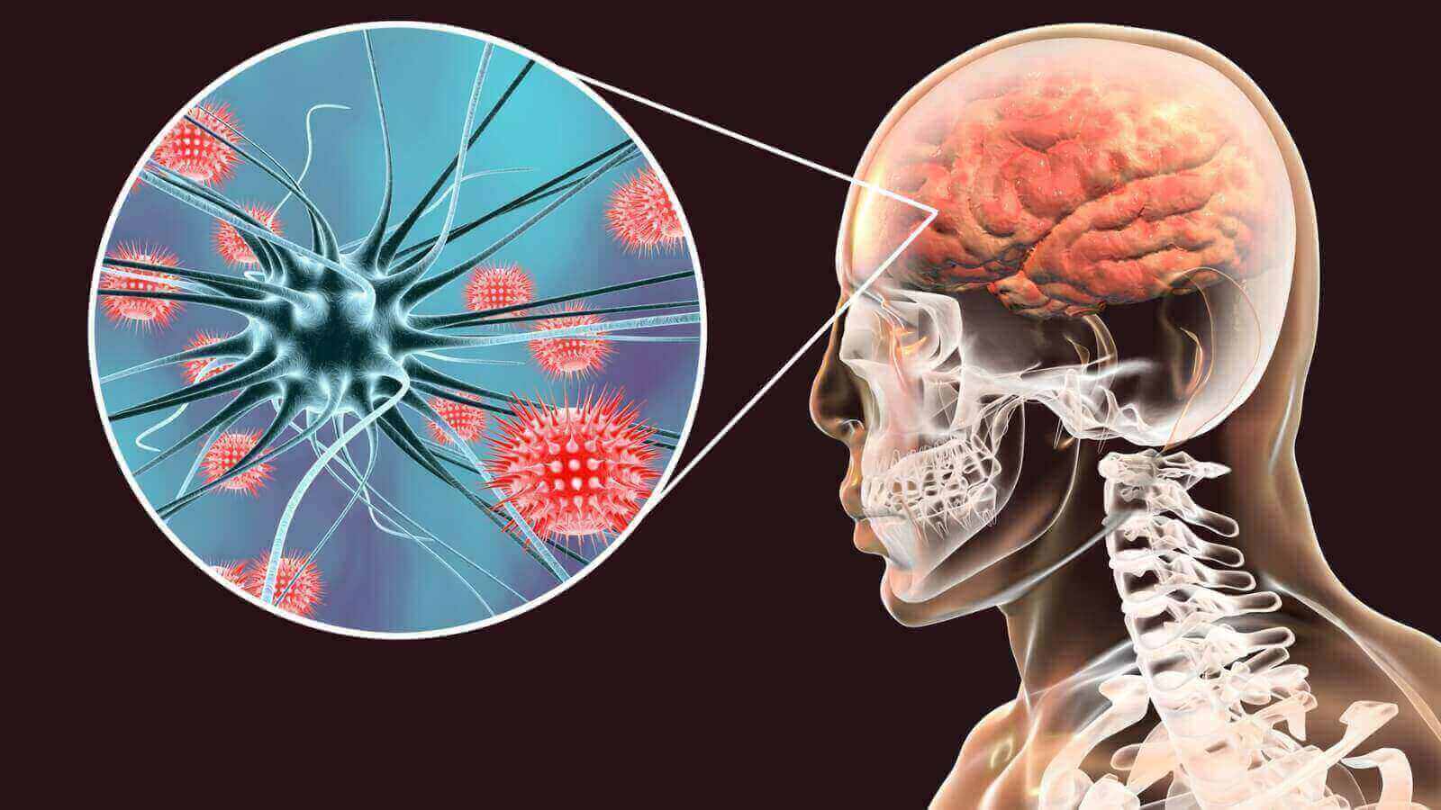 Murieron 2 mujeres por meningitis