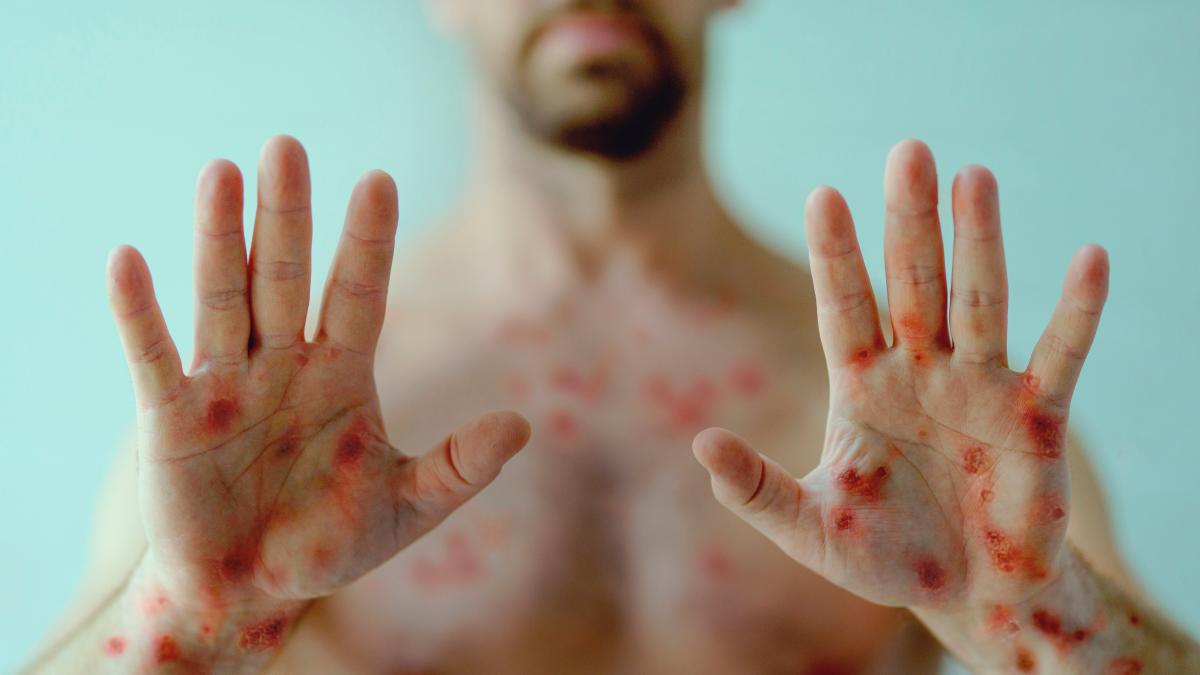 Viruela símica en Tamaulipas