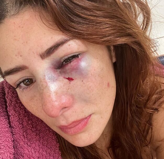 La atleta mexicana, Daniela López Mejía, denuncia a su pareja tras recibir golpiza. Presentó una fractura en el hueso nasal izquierdo.