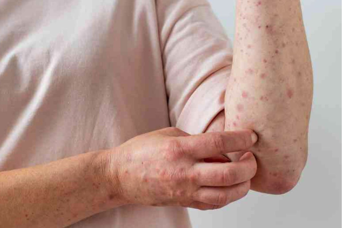 Tamaulipas viruela del mono